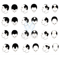 【bbin宝盈基因检测】过早<font color='red'>脱发</font>、掉发太多怎么办？你的方法可能是错的！